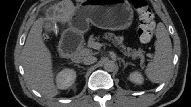 Recurrent liver abscess