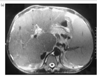 He was wrongly diagnosed as chronic liver disease