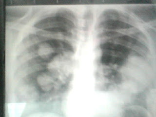 Shortness of Breath in a young male